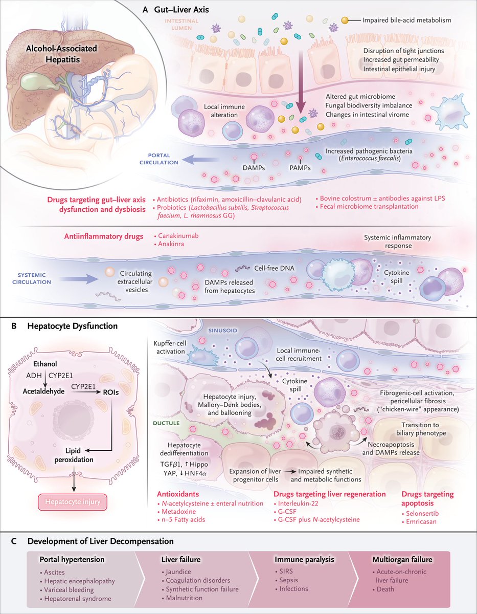 john_damianosMD's tweet photo. Expert review on alcohol-associated hepatitis. 

#MedTwitter #LiverTwitter #Liver #GITwitter #AlcHep #MedEd @NEJM 

https://t.co/HkrQcJCOCN https://t.co/x7gjC7YWVu