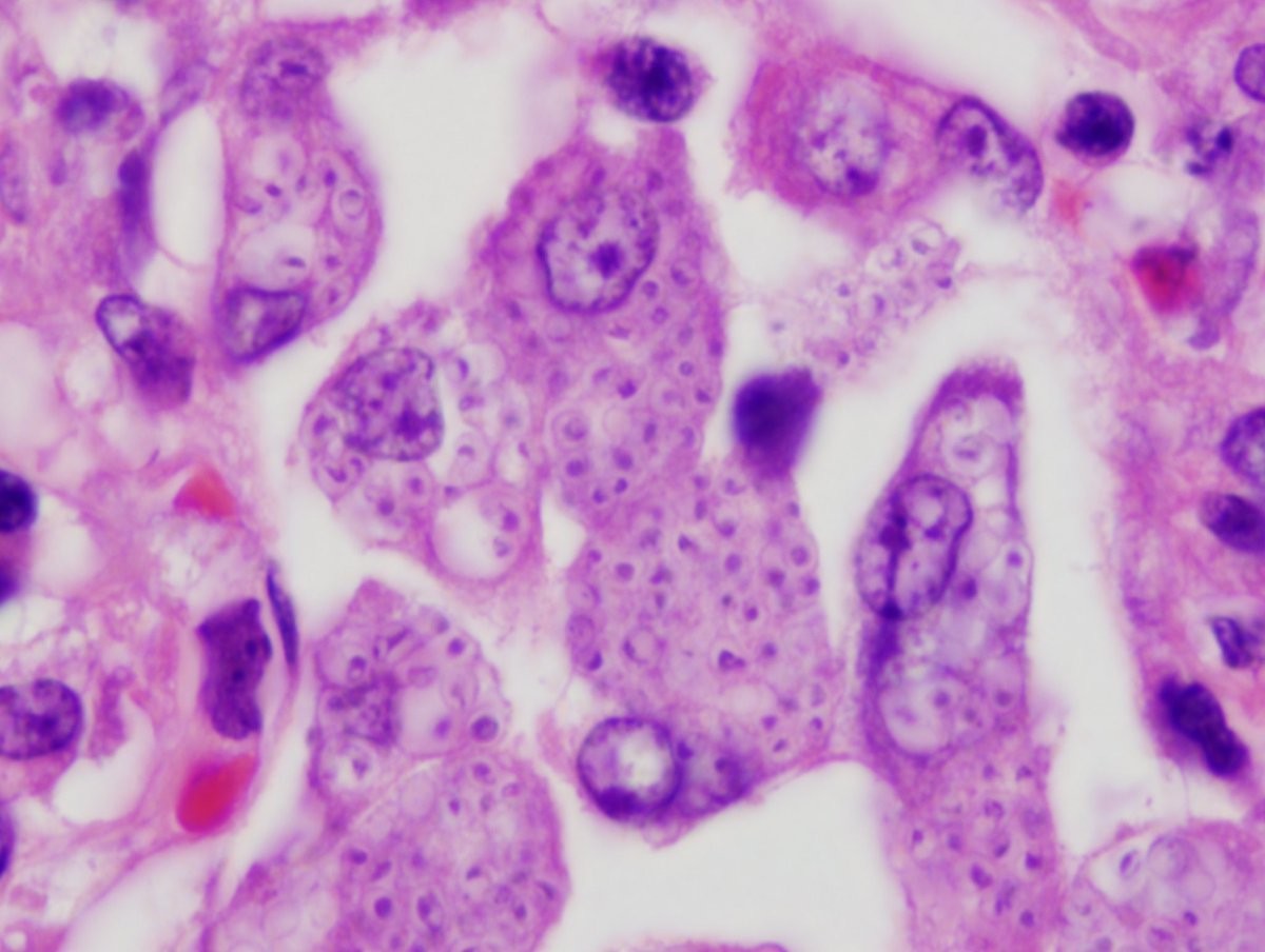 smlungpathguy's tweet photo. Disseminated histoplasmosis: In the lungs of people who live in endemic for histoplasmosis, necrotizing granulomas (histoplasmomas) containing Histoplasma yeasts are common.  The fungus never grows... https://t.co/D5GKloC8R8 https://t.co/dTpJeBVpwt