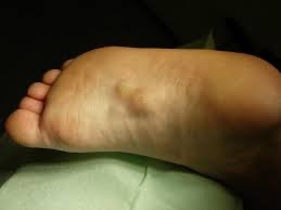 BrownJHM's tweet photo. A patient presented for evaluation of foot pain. Exam w/subcutaneous nodules. What is the likely diagnosis? (Image: medical news today) #medtwitter https://t.co/gSYLMbKmp0