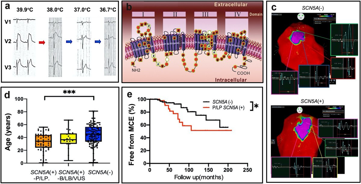 Our international multicenter study found that Fever-induced Brugada syndrome patients with P/LP SCN5A rare variants need more aggressive interventions. authors.elsevier.com/sd/article/S23…