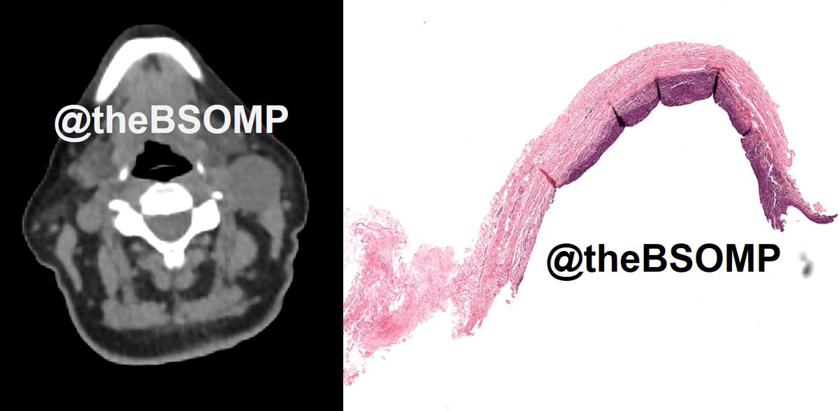 sakhurram's tweet photo. @theBSOMP Case of the Month for January 2023 is now live.

Visit https://t.co/ty7l4MpYak for case history, histology wholeslide image, diagnosis &amp; learning points. 

HAPPY NEW YEAR!

#bsomp #COTM #oralpathology #headandneckpathology #pathology #pathogenesisdigitalpathology https://t.co/OC19q8ikaI
