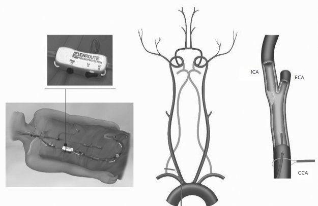 From surgical clamping to endovascular flow arrest/reversal: the concept behind the system, by Cremonesi et al
minervamedica.it/en/journals/mi…
#MinervaCardiologyAngiology
<a href="/cremonesia3/">Alberto Cremonesi</a> <a href="/fracond_94/">Francesco Condello</a>