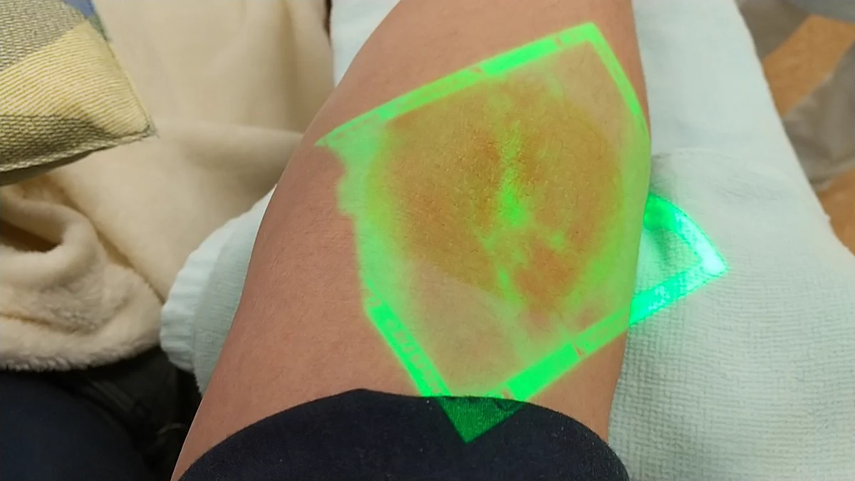 血管が出にくい人に朗報！光を当てると血管が見える新兵器！！