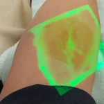 血管が出にくい人に朗報!光を当てると血管が見える新兵器!