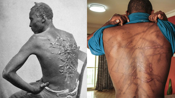 On the left, is a 1863 actual picture of "Whipped Peter/Gordon" who survived American slavery. 

On the right, is a 2022 actual picture of novelist Kakwenza Rukirabashaija who survived Ugandan security torture