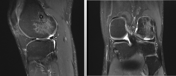 iccimplanteC's tweet photo. 💥Las lesiones #condrales son difíciles de diagnosticar:
🩻No se aprecian bien en las RM habituales
🔹Se producen junto a otras lesiones de la articulación
🥼El diagnóstico más fiable para estas lesiones es por cirugía abierta o #artroscopia ⬇️
https://t.co/8IwnB1mapg https://t.co/Khdbdeiogn