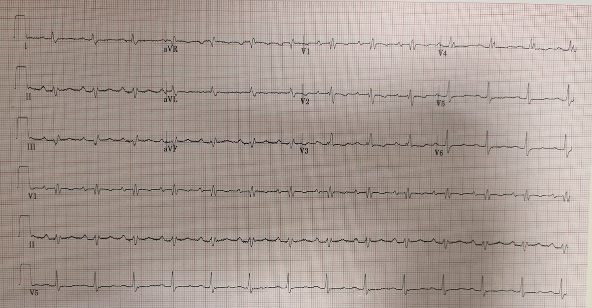 Federico Sanguettoli (@fsanguettoli) on Twitter photo 60y 👨🏼🦳, admitted for fever.
Echography requested to rule out endocarditis (fortunately, there wasn't).
What did we found?
Woud u have suspected the anomaly looking at the EKG?
<a href="/ritapavasini87/">ritapavasini</a>
<a href="/Fra_Vitali90/">Francesco Vitali</a> <a href="/A_Boccadoro_MD/">Alberto Boccadoro</a> <a href="/ElisabettaBex/">Elisabetta Tonet</a> <a href="/NicolaBianchi95/">Nicola Bianchi</a> <a href="/Feff93/">Federico Marchini</a> <a href="/cant4nna/">Anna Cantone</a> 60y 👨🏼🦳, admitted for fever.
Echography requested to rule out endocarditis (fortunately, there wasn't).
What did we found?
Woud u have suspected the anomaly looking at the EKG?
<a href="/ritapavasini87/">ritapavasini</a>
<a href="/Fra_Vitali90/">Francesco Vitali</a> <a href="/A_Boccadoro_MD/">Alberto Boccadoro</a> <a href="/ElisabettaBex/">Elisabetta Tonet</a> <a href="/NicolaBianchi95/">Nicola Bianchi</a> <a href="/Feff93/">Federico Marchini</a> <a href="/cant4nna/">Anna Cantone</a>