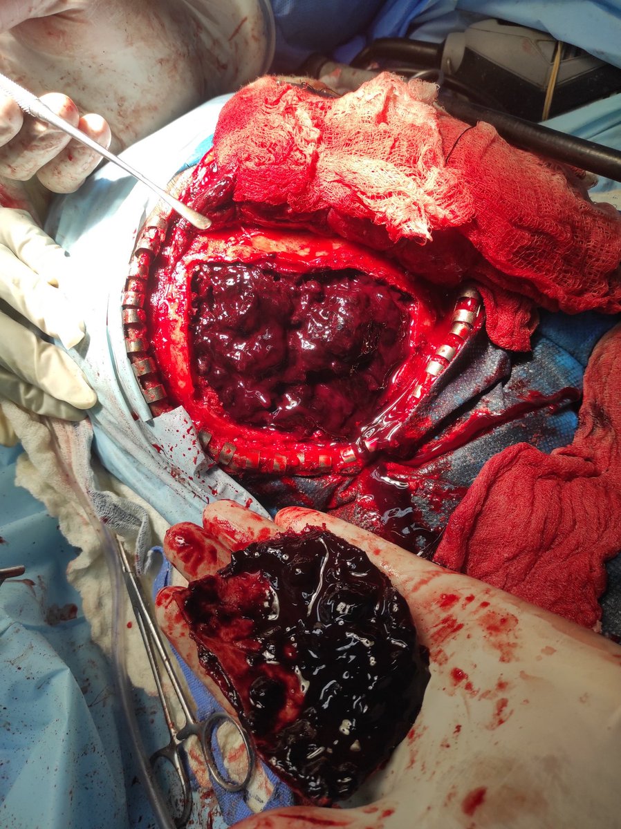 DrPRBC's tweet photo. Así luce un hematoma epidural. No fue el caso de este paciente, pero espero que muchos motorizados que andan sin casco puedan ver esta foto. Cuídense. https://t.co/RhK1tA0nft