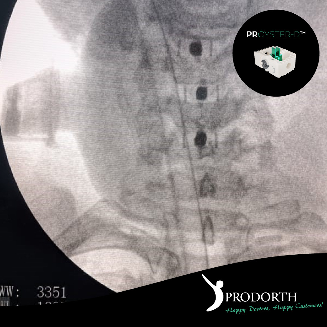 🎯Anterior Cervical Peek Cages & Bladed
PROYSTER-D™️

📍 Dominican Republic

#prodorthspine #spinehealth #spinesurgery #spinedoctor #motionpreservation #spineimplant #spinedevice #cervicalcage #anteriorcervicaldiscectomyandfusion #postoperative