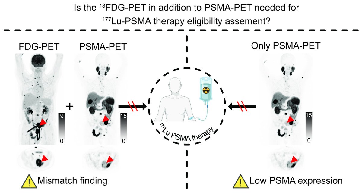 JNM (@journalofnucmed) on Twitter photo Do we need FDG PET/CT prior to PSMA-targeted radiopharmaceutical therapy? ow.ly/WI3e50M9ozP
#NuclearMedicine #RPTherapy #ProstateCancer <a href="/ProfKHerrmann/">Ken Herrmann</a> <a href="/ProfHadaschik/">Boris Hadaschik</a> Do we need FDG PET/CT prior to PSMA-targeted radiopharmaceutical therapy? ow.ly/WI3e50M9ozP
#NuclearMedicine #RPTherapy #ProstateCancer <a href="/ProfKHerrmann/">Ken Herrmann</a> <a href="/ProfHadaschik/">Boris Hadaschik</a>