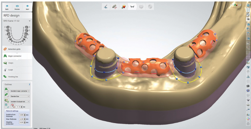 InDentalTech's tweet photo. In case you missed it! #MasterClassFlashback: “Utilizing Fiber-Composite Frameworks to Reinforce Overdentures” by Michael D. Scherer, DMD, MS https://t.co/wtnKEdklo3 https://t.co/QPEosN3koj