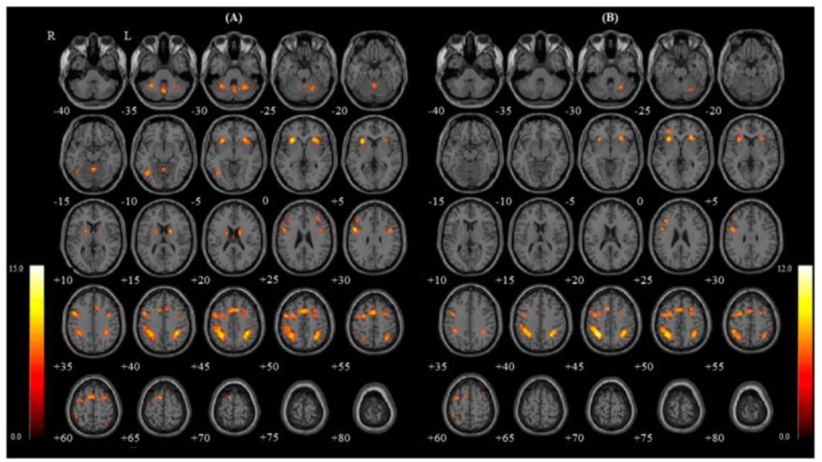 bpoppenheimer's tweet photo. Researchers studied the effects of nasal and mouth breathing on brain function.

The results are interesting... https://t.co/rru7Ltad9J