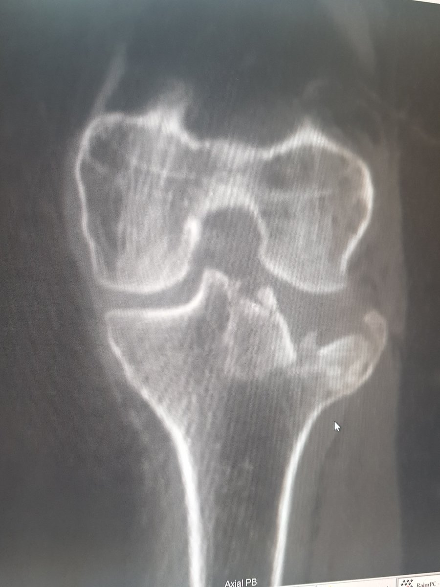 AlbertoLopezAr1's tweet photo. Fractura hundimiento meseta tibial (foto):

- reducción articular con Asistencia Artroscópica (video pre y postreducción).
- fijación temporal con aguja (foto).
- fijación definitiva con placa VA tibial (foto).

#Trauma #knee #artroscopia 
@AristidesDoleo https://t.co/LQPTz3MN9u