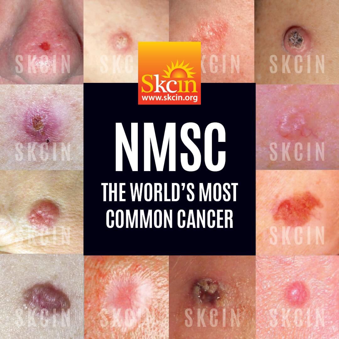 SkcinCharity's tweet photo. NMSC - Non-melanoma Skin Cancer is globally the most common form of cancer. 1 in 4 UK males and 1 in 5 UK females will be diagnosed with NMSC in their lifetime - and if diagnosed once, you could have many more!
https://t.co/cAzYIsuTAo https://t.co/6ByYxcTTQL
