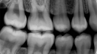 CraigMD84's tweet photo. Medical misconception: 
• Dental x-rays are a dangerous source of radiation.

Fact: 
• A digital dental x-ray has minuscule radiation exposure -- the same amount of radiation you get from eating 10 bananas.

More info 👇

#dentalcare  
#health
#Radiation https://t.co/IeBWKG7XFu