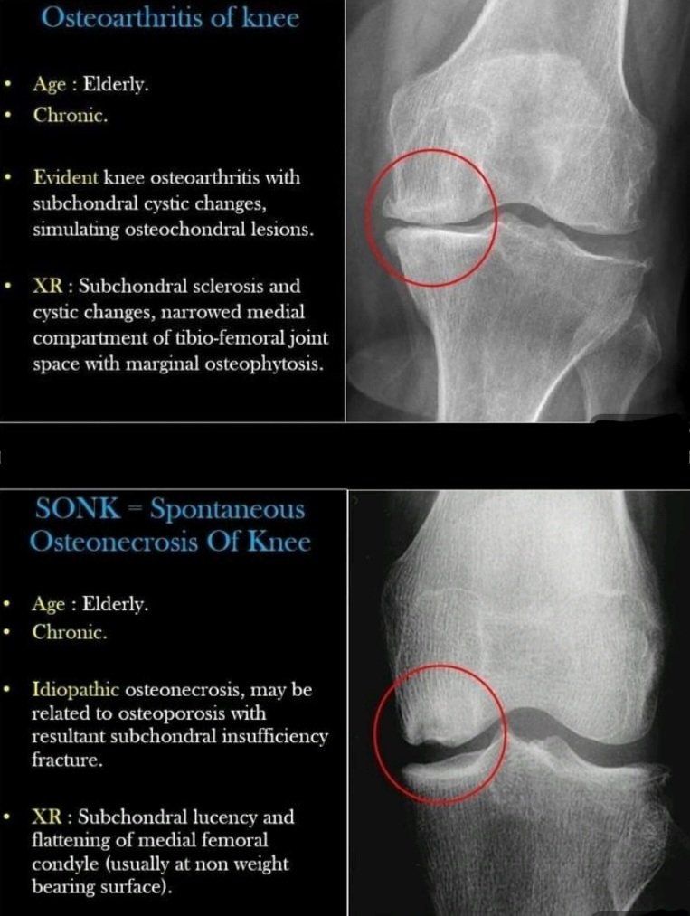 OBandarchi's tweet photo. 🛑AVN vs OA both cause knee pain.
In AVN bonecells die(not getting enough blood). Mostly:medial femoral condyle.
3types: 1)Spontaneous(SONK). 2)Secondary 3)post-arthroscopic
https://t.co/irWl6CVQ6r
OA: degeneration of articular cartilage.
Primary(ageing),Secondary (👉AVN,Gout,..) https://t.co/azpcCEDQiX
