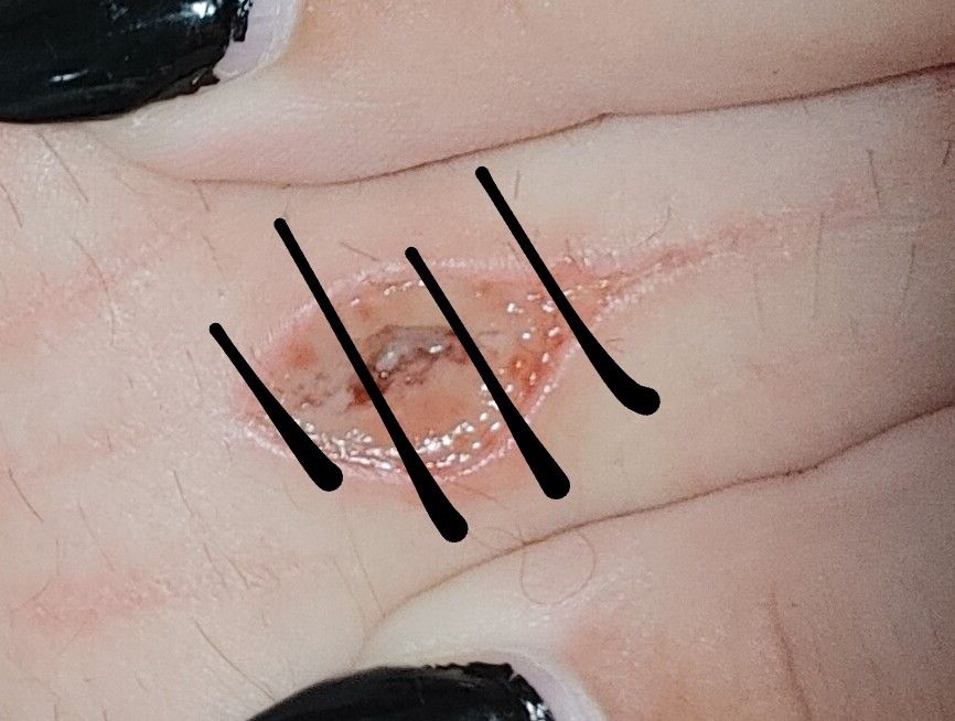 deathbewithus3's tweet photo. throwback to last year lmao, it's almost healed

fake this is for educational purposes only 

988twt beanstwt rasberryfillingtwt ochietwt goretwt cuttingboardtwt redinktwt cvtspo fasciatwt https://t.co/RPj9VqwaQQ