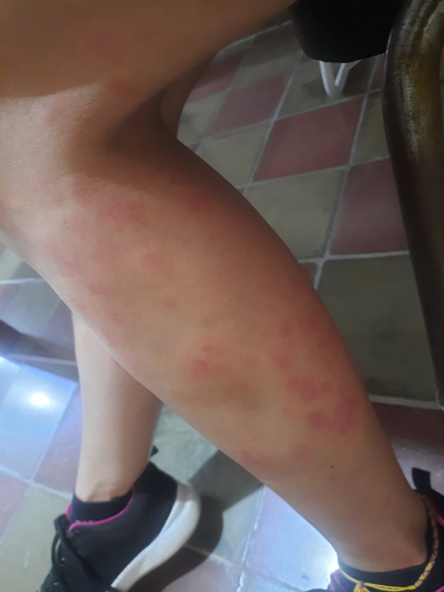 Nunca he visto tanta falta de empatía como la del mosquito que, viéndome con urticaria y todo, viene y me pica. Maldito