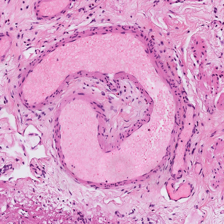 olkazuraw's tweet photo. I found this vessel that has this heart-shaped indentation for you on PathPresenter.
Look at the erythrocytes inside. I need to save this one for Valentine's :)

In the meantime Merry post-Christmas

#Pathart #pathheart #Ihearthisto #Iheartpathology #pathpresenter https://t.co/cDUBzsAIQ1