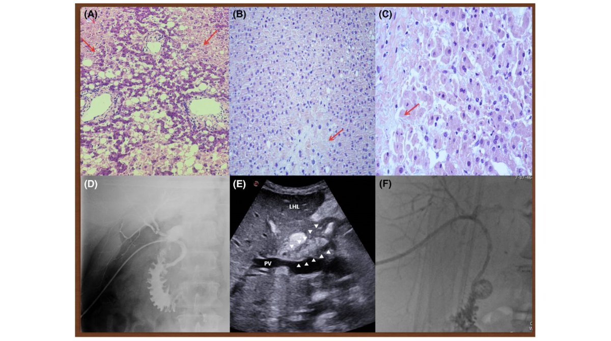 Artificial Organs (@artiforgans) on Twitter photo The role of sequential #Normothermic regional #Perfusion and end-ischemic normothermic machine perfusion in #LiverTransplantation from very extended uncontrolled #Donation after cardiocirculatory death
#OnlineFirst๐bit.ly/3GsFV0T
<a href="/Unipisa/">Universitร di Pisa</a>๐ฎ๐น| <a href="/DavideGhinolfi/">Davide Ghinolfi</a> #ExSitu The role of sequential #Normothermic regional #Perfusion and end-ischemic normothermic machine perfusion in #LiverTransplantation from very extended uncontrolled #Donation after cardiocirculatory death
#OnlineFirst๐bit.ly/3GsFV0T
<a href="/Unipisa/">Universitร di Pisa</a>๐ฎ๐น| <a href="/DavideGhinolfi/">Davide Ghinolfi</a> #ExSitu