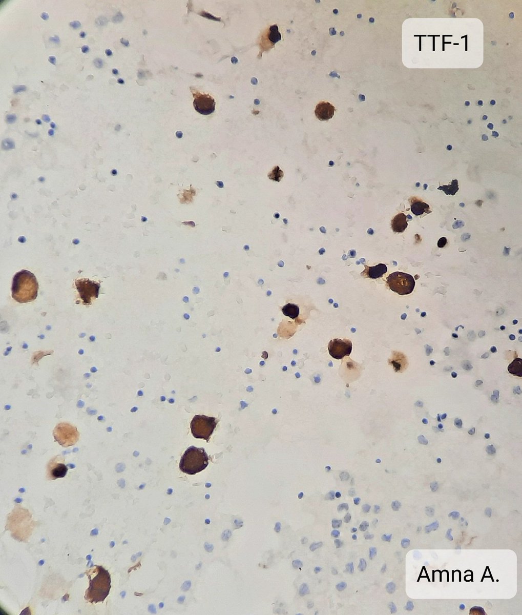 amnabruno's tweet image. Pleural fluid 52 years female. 
#MedTwitter #TwitterPath #PathTwitter #Cytology #lungdisease