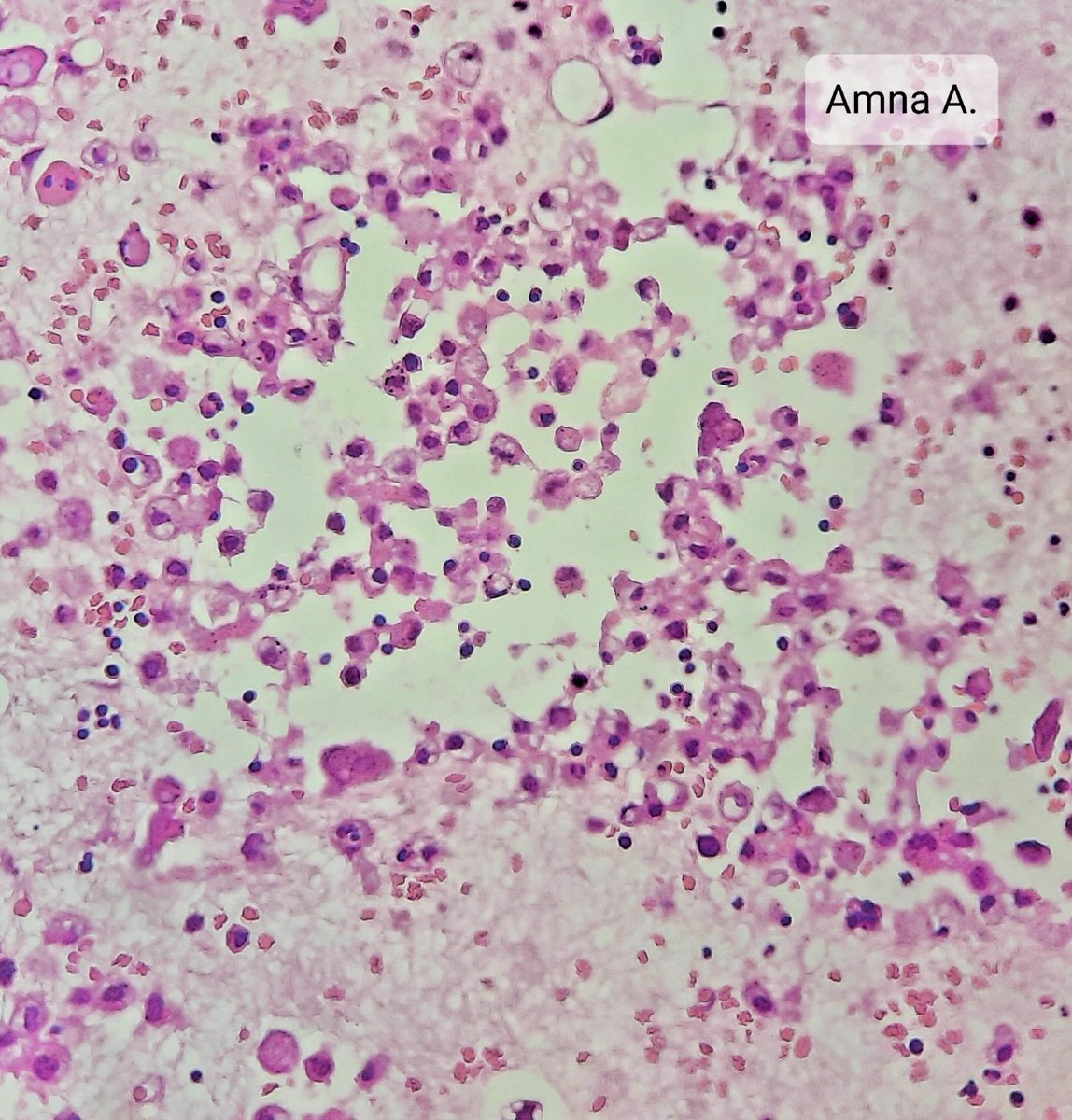 amnabruno's tweet image. Pleural fluid 52 years female. 
#MedTwitter #TwitterPath #PathTwitter #Cytology #lungdisease