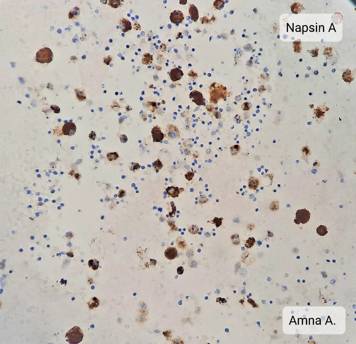amnabruno's tweet image. Pleural fluid 52 years female. 
#MedTwitter #TwitterPath #PathTwitter #Cytology #lungdisease