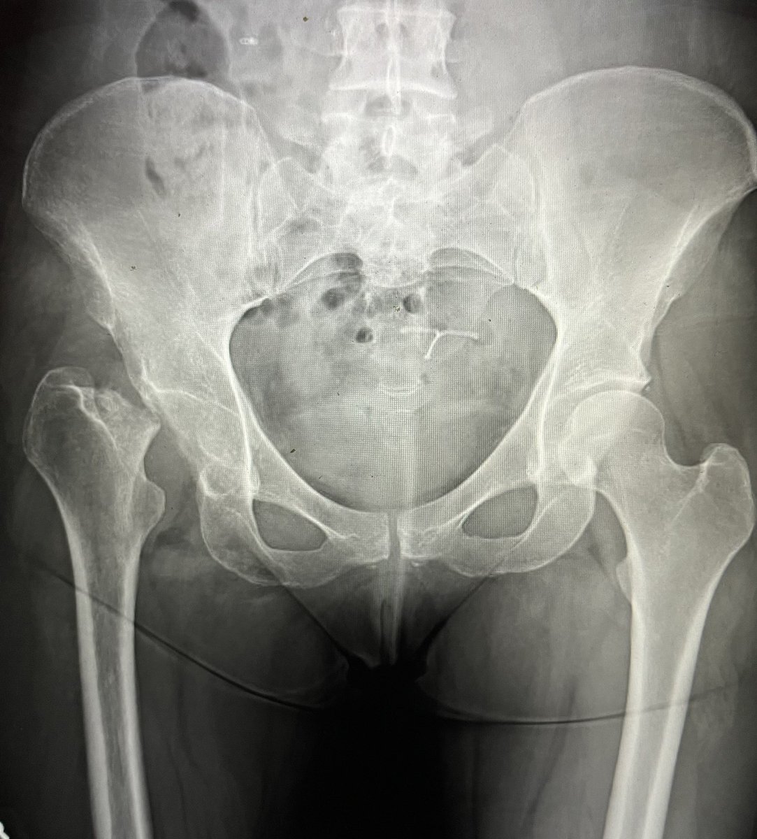 This walks into clinic. MVA 6 mo ago, seen at OSH, told needs surgery but discharged. “I broke my hip and the bone died”. Hasn’t been able to get care until now 2/2 being “elective”. What are you doing? #orthotwitter