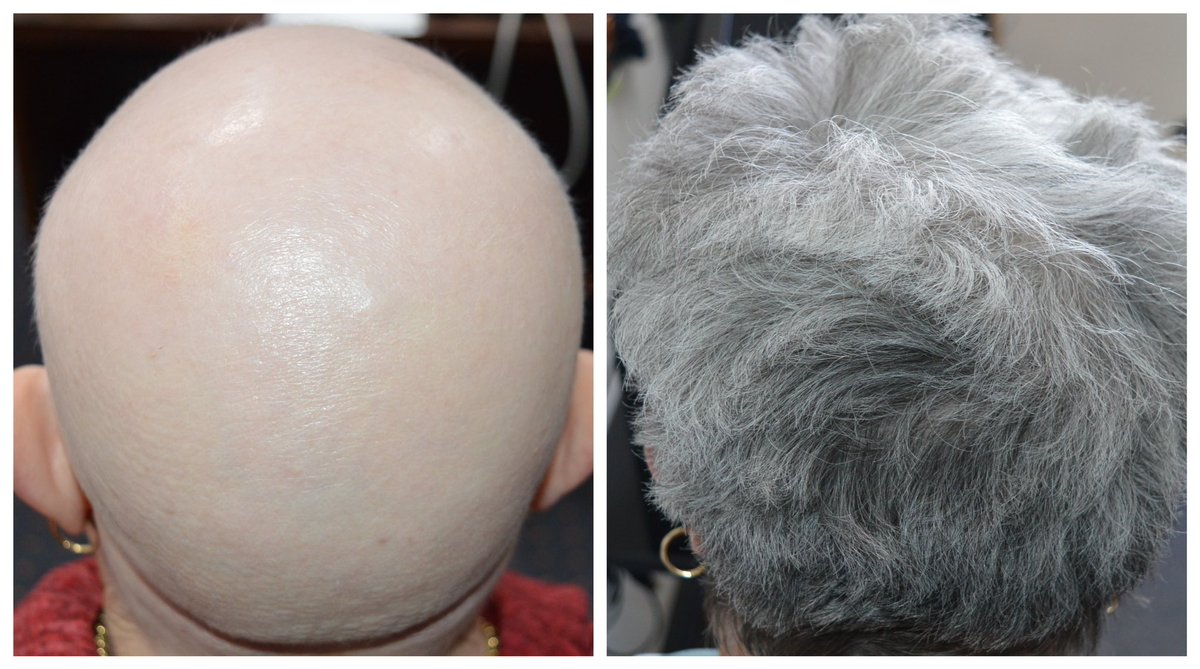 Lovely to wrap up #2022 with #SuccessStory of a 62-year-old with #Alopecia totalis who regrew all her #hair
#HairLoss can have a devastating impact on #selfesteem regardless of age. Patients of all ages deserve access to appropriate #treatment 
#dermtwitter #dermatology
