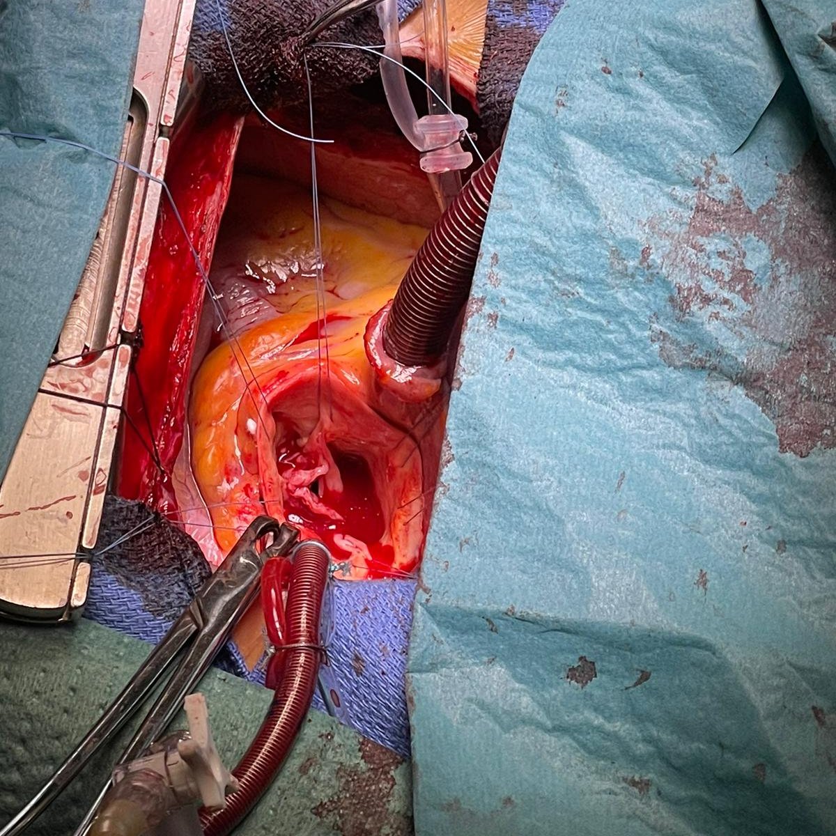 jisaezdeibarra's tweet photo. Bicuspid aortic valve repair. Decalcification fused R-l. Annuloplasty #HAART200 25mm. Free edge reconstruction with aorta patch. Free edge plication and alignment to 38 mm. https://t.co/lb2lzWVA8c