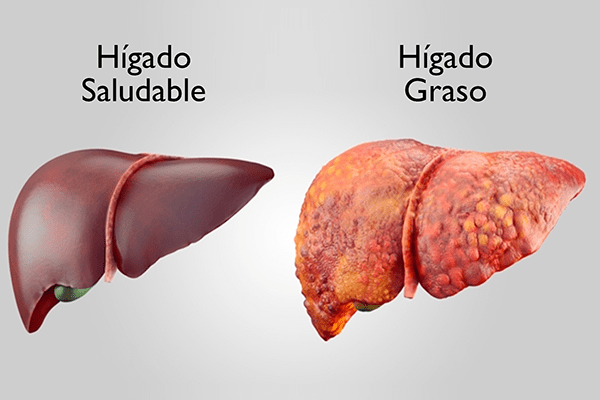 PeriodicoHoy's tweet photo. Hígado graso no alcohólico
Más información en nuestra sección #ConsultorioDeNutriciónHOY
#PeriódicoHOY #HOYDigital #ElHOY #Hígado #HígadoGraso #EHGNA
https://t.co/0cPP6bdPMf https://t.co/oj5i61il2L