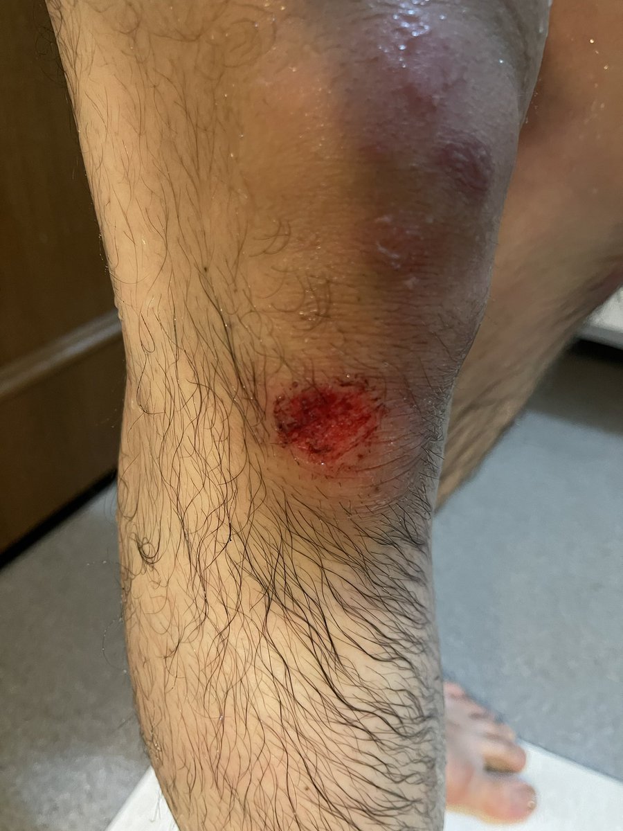 TIME_RXR0115's tweet photo. マウンテンバイクで階段駆け下りてたら転けた
大したことないと思ってたら意外とでけ��な https://t.co/FDov3cbgJh