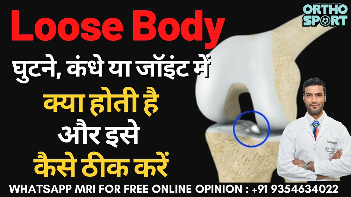 drmanubora's tweet photo. घुटने, कंधे या किसी जॉइंट में लूज़ बॉडी है तो क्या करें ? Loose Body Causes, Treatment, Complete Info 
Checkout full video on YouTube- https://t.co/LXrTylAmHl https://t.co/Ss98iOJ910