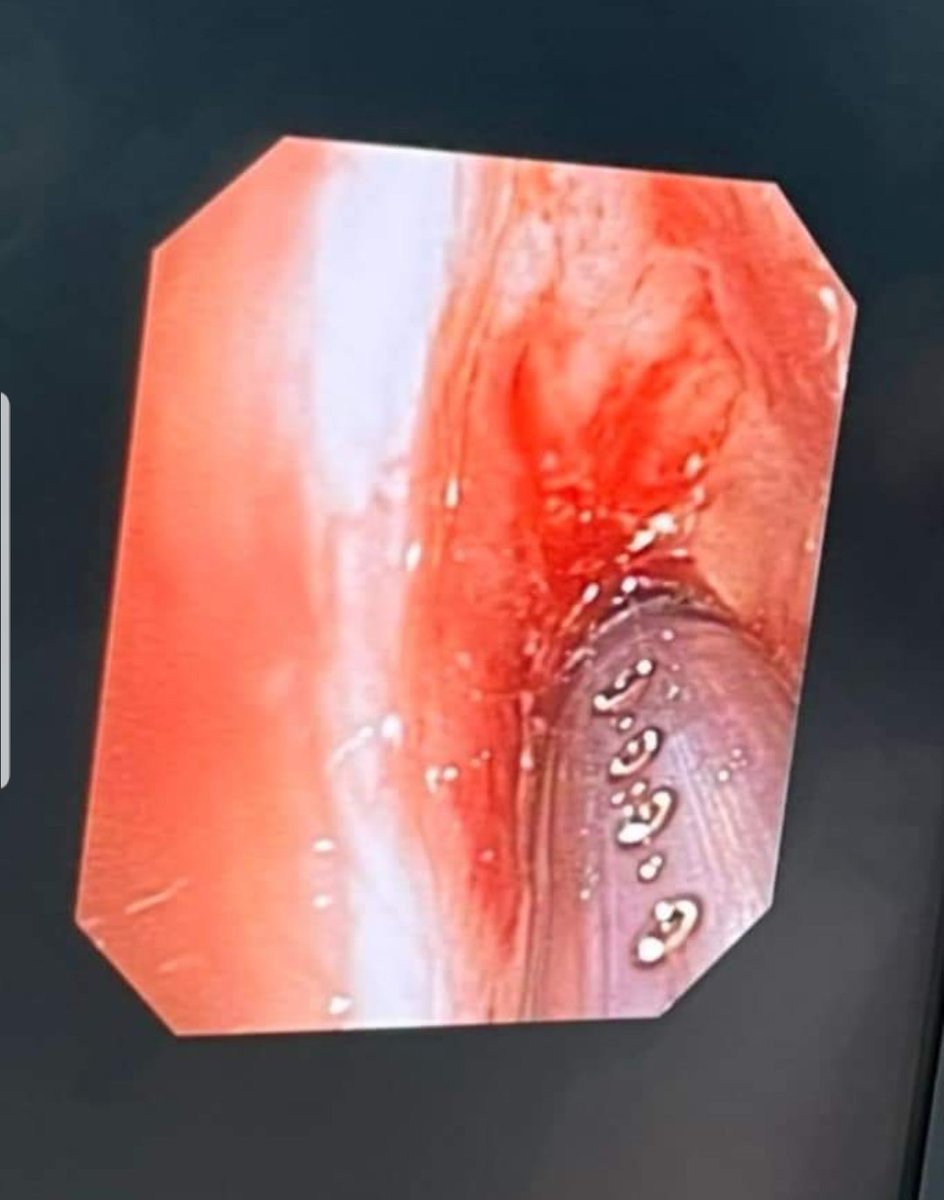 ArvinAlaga's tweet photo. #CHESTAlorSetar
Our team assisted ORL team in post-TB subglottic stenosis.
A young lady suffered from post-TB subglottic stenosis with critical narrowing of trachea ard 5mm and the stenosis located 1.7cm from the vocal cord;the length of the affected segment was approximately 2cm https://t.co/nhon9DFLc6