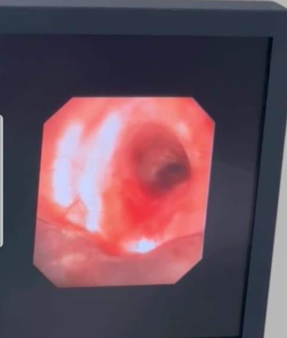 ArvinAlaga's tweet photo. #CHESTAlorSetar
Our team assisted ORL team in post-TB subglottic stenosis.
A young lady suffered from post-TB subglottic stenosis with critical narrowing of trachea ard 5mm and the stenosis located 1.7cm from the vocal cord;the length of the affected segment was approximately 2cm https://t.co/nhon9DFLc6