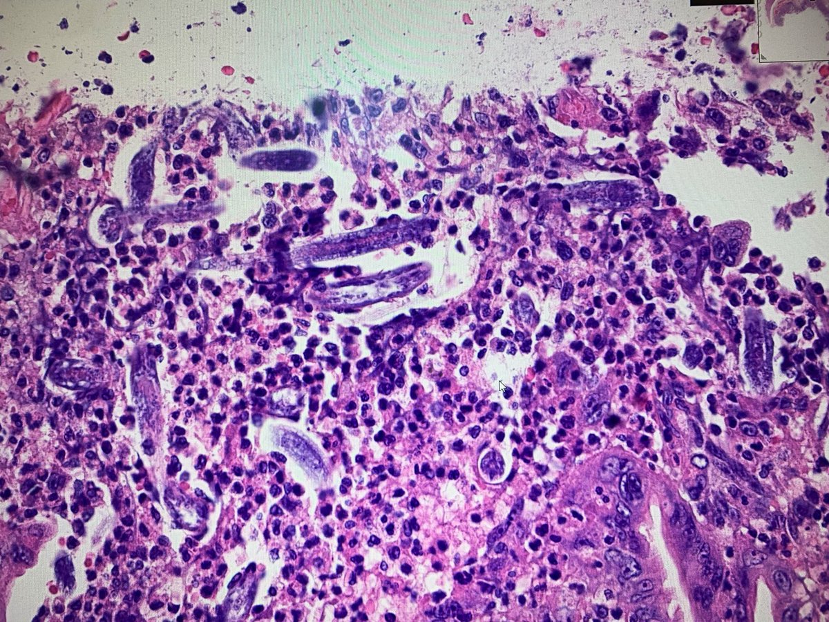 igorostixe's tweet photo. Another image of the larvaes. Spectacular colonic infestation. https://t.co/YaNdcK1raO