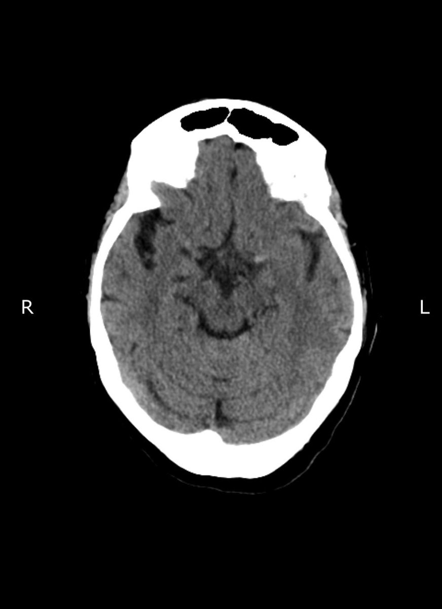 ingrid_kane's tweet photo. Despite all the unbelievable pressures on the NHS we have just completed our 3rd thrombectomy of the day @UHSussex. Life changing treatment - what a team I have the privilege of working with @sussexisdn @Brainomix https://t.co/zlcq4IHerY