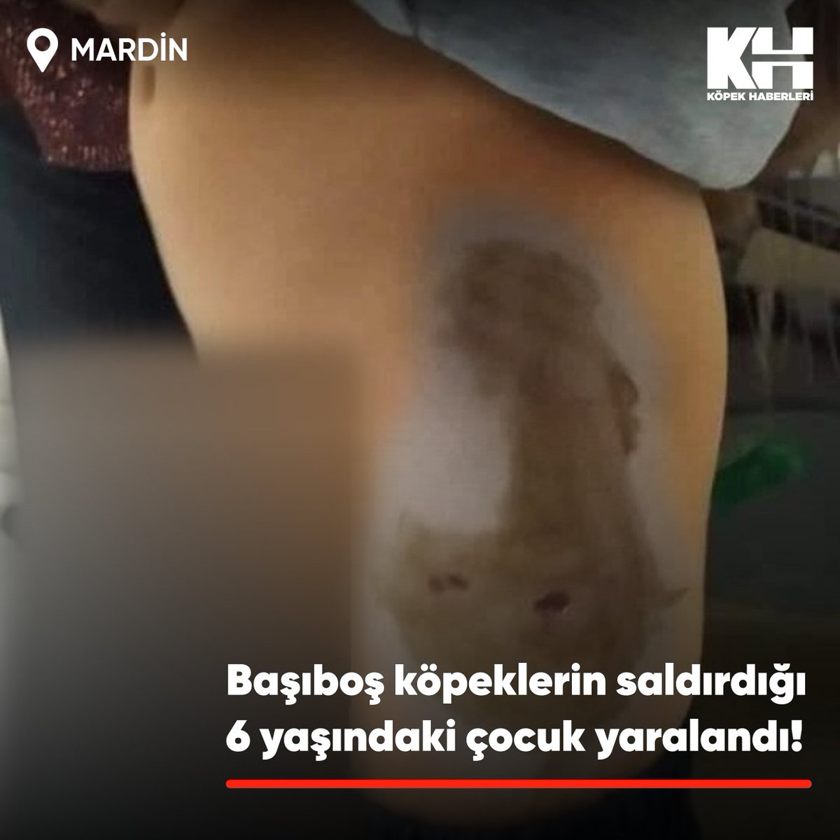 Mardin'in Kızıltepe ilçesinde 2 başıboş köpek 6 yaşındaki D.Ç.'ye saldırdı.
#kuduz .
Bacağından yaralanan çocuk, babası tarafından Kızıltepe Devlet Hastanesine götürüldü.