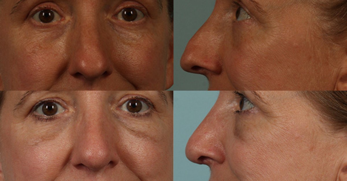 MariettaPlastic's tweet photo. Before &amp; After: Rhinoplasty 👃

Rhinoplasty is the surgical correction of nasal issues. Regardless of the type of issue, correcting a nasal problem can have a major positive impact on a patient’s quality of life.

Learn more: ⤵️
https://t.co/xUFgp9L6Ii https://t.co/zByVcYwBgl