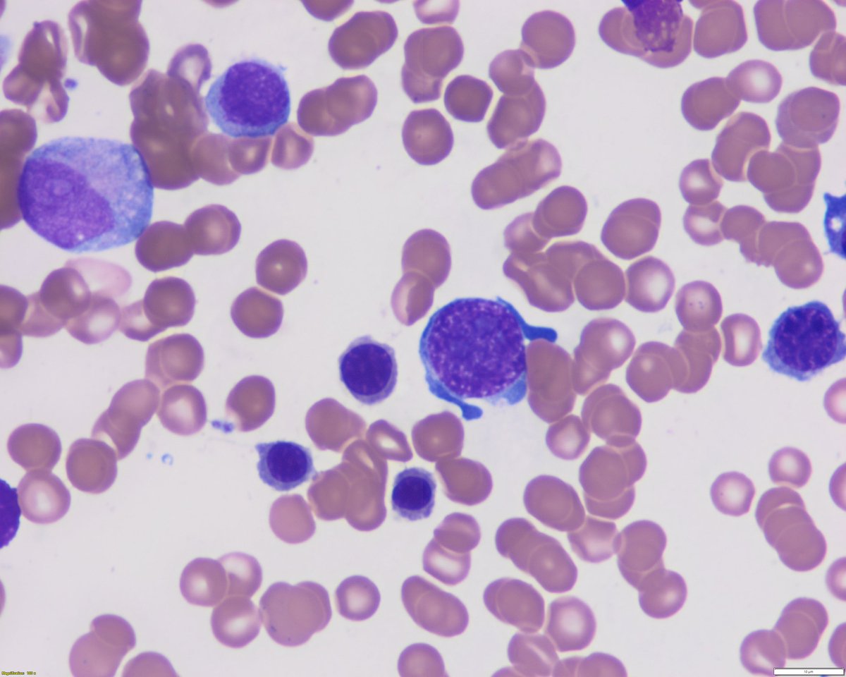 Sanam Loghavi, MD صنم لغوی 🔬🧬 tweet media