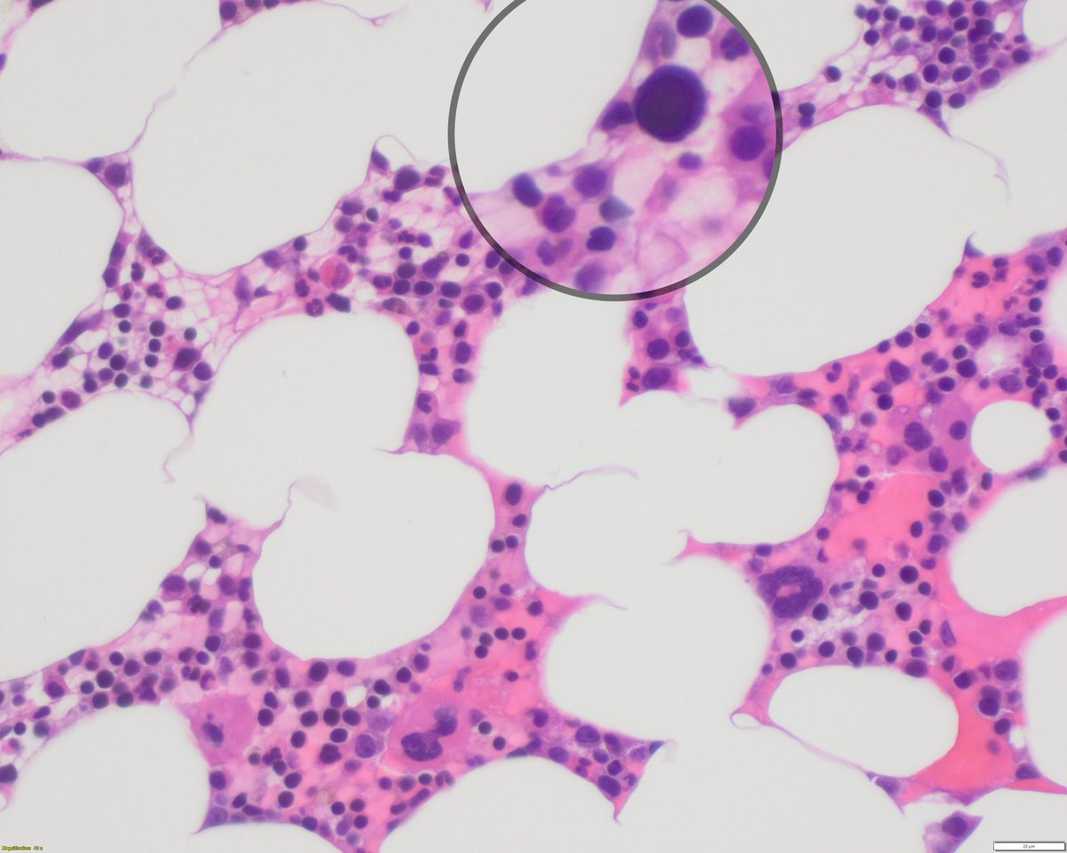 Sanam Loghavi, MD صنم لغوی 🔬🧬 tweet media