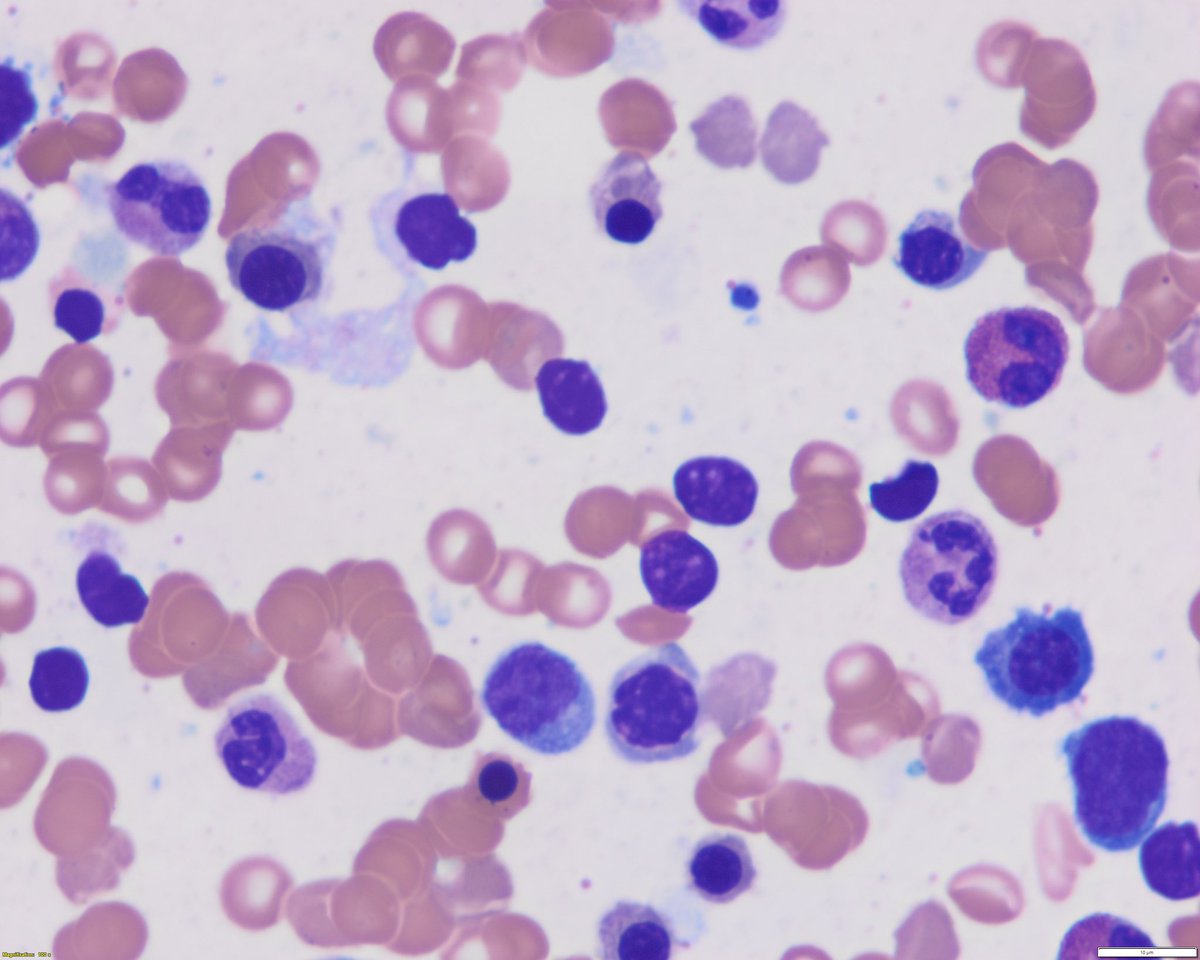 Sanam Loghavi, MD صنم لغوی 🔬🧬 tweet media