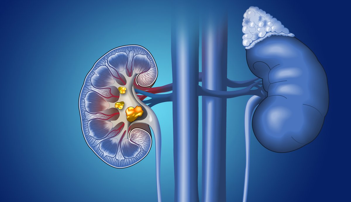 jyotika_somal's tweet photo. Clinical_Renal: How can I prevent kidney stones?
To help prevent future kidney stones, you also need to know what caused your previous kidney stones. @NIDDKgov
Read here - https://t.co/EDynJx4a7b
#health #dialysis #transplant #KidneyDisease #CKD #Clini… https://t.co/JWRcvsdLEY