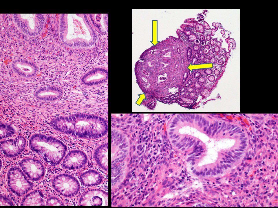 GaryKeeneyMD's tweet photo. GI pathology for trainees. 40 YO/F with blood in stools.  Colonoscopy identifies polyp at 20 cm.  Your diagnosis = https://t.co/HSyBgHKqeL