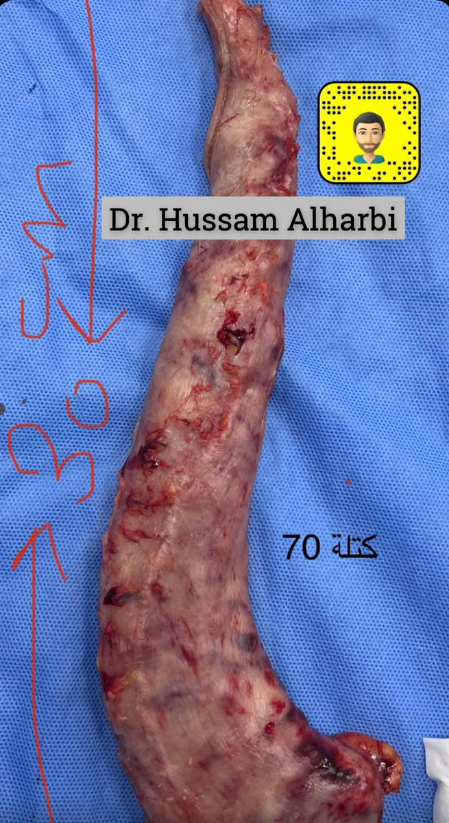 عملية تكميم لمريض بكتلة 70 ماشاءالله 

الحمدلله على سلامة مريضنا .. قدامه العافيه 

والاستفسار يرجى التواصل على الواتس اب او الخاص 
.
.
📲0505728558

#رابطة_المتكممين #تكميم_المعدة #فضفضة_المتكممين #منتدى_المتكممين #متكممين_الدكتور_حسام_الحربي