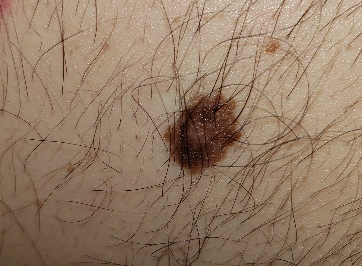 MathieuNicolas_'s tweet image. #DocTocToc #dermato Bonjour, un avis les dermato ?
Environ 1cm