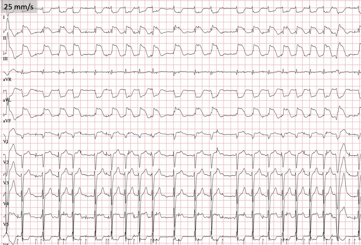 #EPeeps  82 yo female, hospital admission with ventricular fibrillation, 1x extern defibrillation. Here’s ECG after defibrillation. What do you see? What is the next step?
#Cardiotwitter #FOAMed #EP_Kiel #ECG <a href="/CardiologyNerd/">Sebastian Jäger</a> <a href="/sebFeickert/">Sebastian Feickert</a> <a href="/doctor_roig/">Dr. Roig</a> <a href="/HenrikeHillmann/">Henrike Hillmann</a>