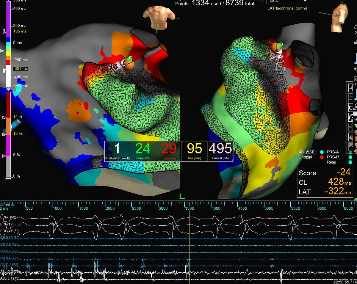 Ganesh Venkataraman (@gvenkataramanep) on Twitter photo Gorgeous EGMs on HD grid <a href="/AbbottCardio/">Abbott Cardiovascular</a> allowing for single burn termination on LAA - LUPV ridge micro-re-entrant flutter. #epeeps #singleburnterm <a href="/DrRoderickTung/">Roderick Tung</a> <a href="/srissundaram/">Sri Sundaram</a> - mapped by Denver’s elite Ensite team <a href="/samsmithep/">Samantha Smith</a> Gorgeous EGMs on HD grid <a href="/AbbottCardio/">Abbott Cardiovascular</a> allowing for single burn termination on LAA - LUPV ridge micro-re-entrant flutter. #epeeps #singleburnterm <a href="/DrRoderickTung/">Roderick Tung</a> <a href="/srissundaram/">Sri Sundaram</a> - mapped by Denver’s elite Ensite team <a href="/samsmithep/">Samantha Smith</a>