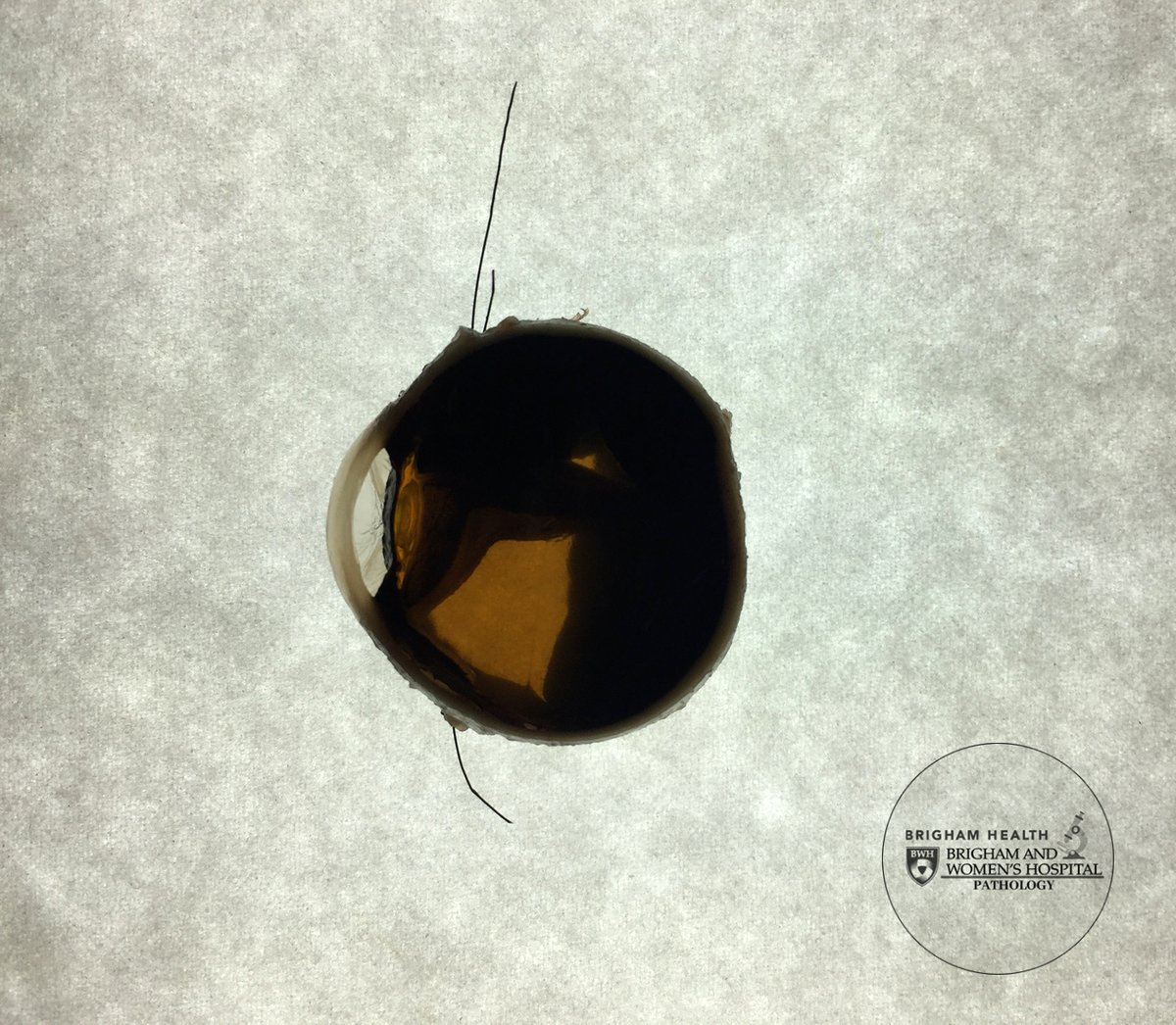 Hello and welcome to the Gross Case of the Week – Neuro Winter Edition! This week we have a rare surgical case. Can you guess what is pictured here? #GrossCOTW #NeuroWinter #PathAssist