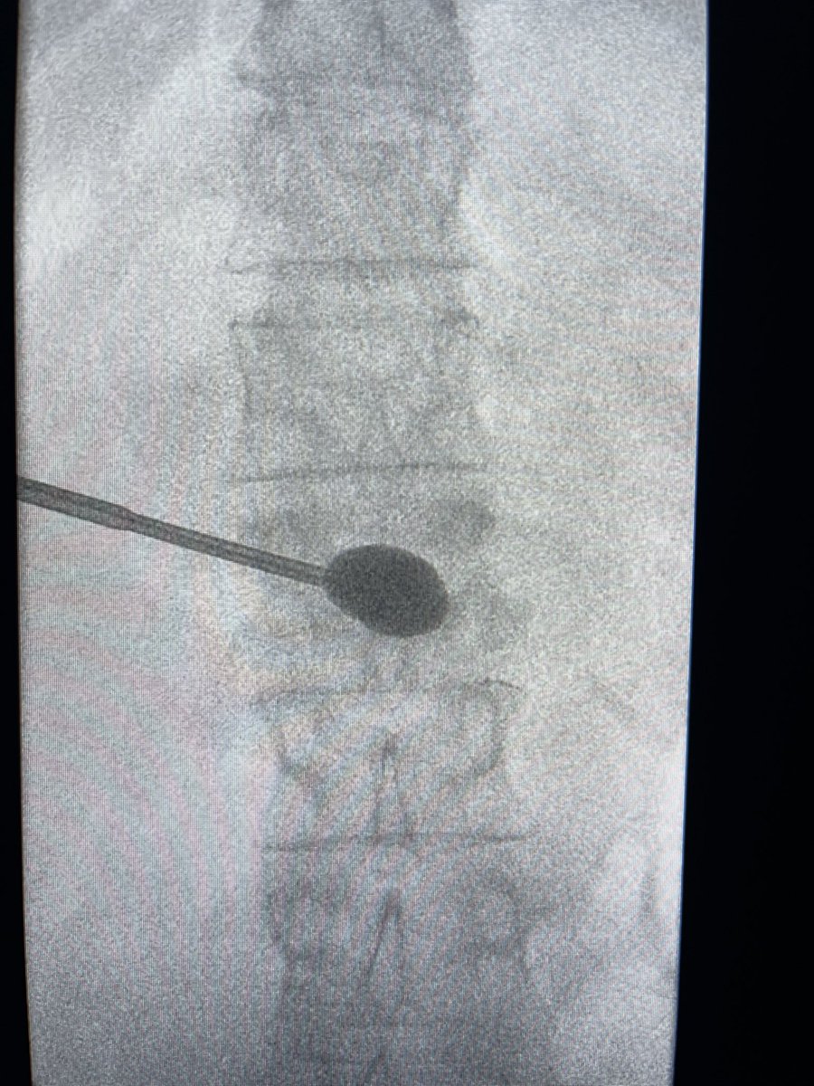 darthglader's tweet photo. The balloon inflates in the midline. Then reach #fillgoals with cement. Good fill of the fracture line, with a titch in the superior endplate and through the inferior endplate.

Patient had complete resolution of her back pain for the first time in weeks. 

#MSKIRFTW https://t.co/d6bsbv8jaS